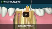 【希平方英文報】看完牙齒怎麼酸酸的...兩分鐘搞懂根管治療